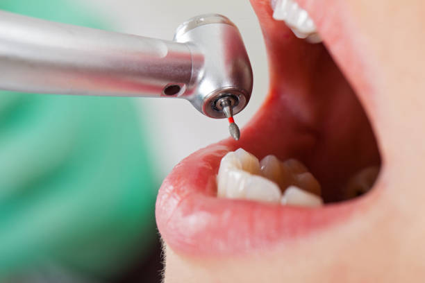 Best Chipped Tooth Repair Near Me  in Alhambra, CA